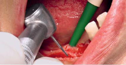 Bone Cuts: med, fine, superfine